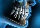 Имплантация зуба - просто и быстро