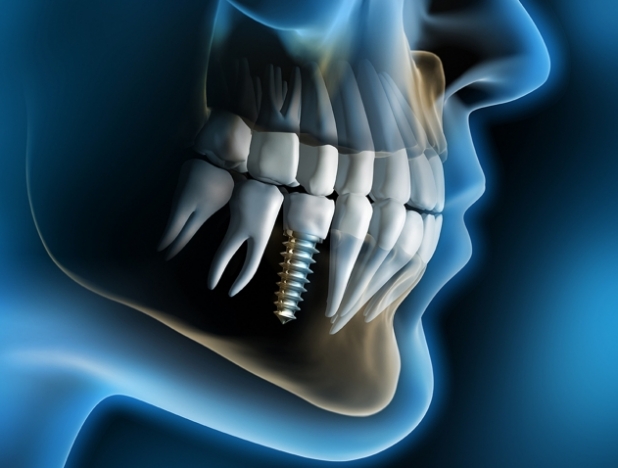 Имплантация зуба - просто и быстро
